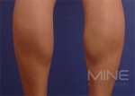 Mine Plastic Surgery, Reviews, Images, Promotions — Korea cost, reviews & before-after | MISOODA