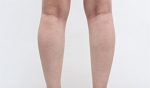 liposuction