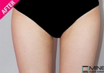 Mine Plastic Surgery, Reviews, Images, Promotions — Korea cost, reviews & before-after | MISOODA