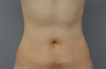 Rovl Avenue Liposuction,Reviews,Images, Promotions — Korea cost, reviews & before-after | MISOODA