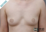 Mine Plastic Surgery, Reviews, Images, Promotions — Korea cost, reviews & before-after | MISOODA