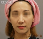 Rovl Avenue Liposuction,Reviews,Images, Promotions — Korea cost, reviews & before-after | MISOODA