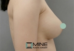 Mine Plastic Surgery, Reviews, Images, Promotions — Korea cost, reviews & before-after | MISOODA