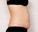 Theline Plastic Surgery,Reviews,Images, Promotions — Korea cost, reviews & before-after | MISOODA