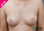 Mine Plastic Surgery, Reviews, Images, Promotions — Korea cost, reviews & before-after | MISOODA