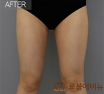 Rovl Avenue Liposuction,Reviews,Images, Promotions — Korea cost, reviews & before-after | MISOODA