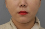 Rovl Avenue Liposuction,Reviews,Images, Promotions — Korea cost, reviews & before-after | MISOODA