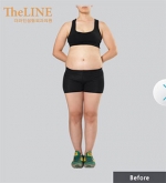 Theline Plastic Surgery,Reviews,Images, Promotions — Korea cost, reviews & before-after | MISOODA