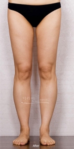 Theline Plastic Surgery,Reviews,Images, Promotions — Korea cost, reviews & before-after | MISOODA