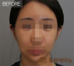 Rovl Avenue Liposuction,Reviews,Images, Promotions — Korea cost, reviews & before-after | MISOODA