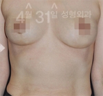 April 31 Plastic Surgery,Reviews,Images,Promotions — Korea cost, reviews & before-after | MISOODA