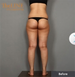 Theline Plastic Surgery,Reviews,Images, Promotions — Korea cost, reviews & before-after | MISOODA