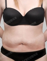 liposuction