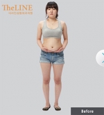 Theline Plastic Surgery,Reviews,Images, Promotions — Korea cost, reviews & before-after | MISOODA