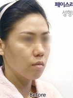 Faceline Plastic Surgery, Reviews,Images,Promotions — Korea cost, reviews & before-after | MISOODA
