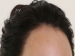 Mojelin Hair Transplant,Reviews,Images, Promotions — Korea cost, reviews & before-after | MISOODA