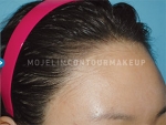 Mojelin Hair Transplant,Reviews,Images, Promotions — Korea cost, reviews & before-after | MISOODA