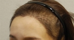 Yonsei Hair transplant Plastic Surgery, Reviews,Images, Promotions — Korea cost, reviews & before-after | MISOODA