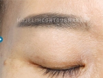 Mojelin Hair Transplant,Reviews,Images, Promotions — Korea cost, reviews & before-after | MISOODA