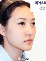 Faceline Plastic Surgery, Reviews,Images,Promotions — Korea cost, reviews & before-after | MISOODA