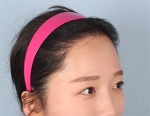 Banobagi Plastic Surgery,Reviews,Images, Promotions, MISOODA — Korea cost, reviews & before-after | MISOODA