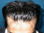 Mojelin Hair Transplant,Reviews,Images, Promotions — Korea cost, reviews & before-after | MISOODA