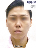 Faceline Plastic Surgery, Reviews,Images,Promotions — Korea cost, reviews & before-after | MISOODA