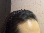 Mojelin Hair Transplant,Reviews,Images, Promotions — Korea cost, reviews & before-after | MISOODA
