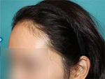 Mojelin Hair Transplant,Reviews,Images, Promotions — Korea cost, reviews & before-after | MISOODA