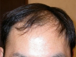 Mojelin Hair Transplant,Reviews,Images, Promotions — Korea cost, reviews & before-after | MISOODA