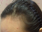 Mojelin Hair Transplant,Reviews,Images, Promotions — Korea cost, reviews & before-after | MISOODA
