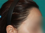 Mojelin Hair Transplant,Reviews,Images, Promotions — Korea cost, reviews & before-after | MISOODA