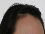 Mojelin Hair Transplant,Reviews,Images, Promotions — Korea cost, reviews & before-after | MISOODA
