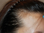 Mojelin Hair Transplant,Reviews,Images, Promotions — Korea cost, reviews & before-after | MISOODA