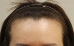 Yonsei Hair transplant Plastic Surgery, Reviews,Images, Promotions — Korea cost, reviews & before-after | MISOODA