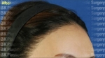 BK Plastic Surgery, Reviews, Images, Promotions — Korea cost, reviews & before-after | MISOODA