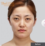 Theline Plastic Surgery,Reviews,Images, Promotions — Korea cost, reviews & before-after | MISOODA