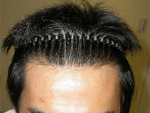 Mojelin Hair Transplant,Reviews,Images, Promotions — Korea cost, reviews & before-after | MISOODA