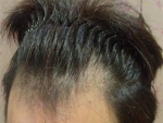 Mojelin Hair Transplant,Reviews,Images, Promotions — Korea cost, reviews & before-after | MISOODA