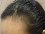 Mojelin Hair Transplant,Reviews,Images, Promotions — Korea cost, reviews & before-after | MISOODA