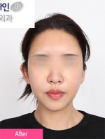 Faceline Plastic Surgery, Reviews,Images,Promotions — Korea cost, reviews & before-after | MISOODA
