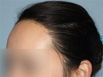 Mojelin Hair Transplant,Reviews,Images, Promotions — Korea cost, reviews & before-after | MISOODA