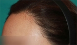 Mojelin Hair Transplant,Reviews,Images, Promotions — Korea cost, reviews & before-after | MISOODA
