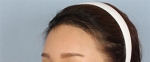 Banobagi Plastic Surgery,Reviews,Images, Promotions, MISOODA — Korea cost, reviews & before-after | MISOODA