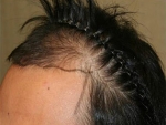 Mojelin Hair Transplant,Reviews,Images, Promotions — Korea cost, reviews & before-after | MISOODA