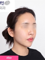 Faceline Plastic Surgery, Reviews,Images,Promotions — Korea cost, reviews & before-after | MISOODA