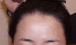 Yonsei Hair transplant Plastic Surgery, Reviews,Images, Promotions — Korea cost, reviews & before-after | MISOODA
