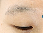 Mojelin Hair Transplant,Reviews,Images, Promotions — Korea cost, reviews & before-after | MISOODA