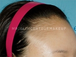 Mojelin Hair Transplant,Reviews,Images, Promotions — Korea cost, reviews & before-after | MISOODA