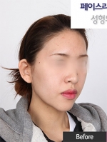 Faceline Plastic Surgery, Reviews,Images,Promotions — Korea cost, reviews & before-after | MISOODA